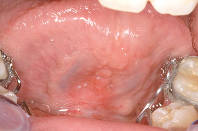 After picture of Frenectomy treatment