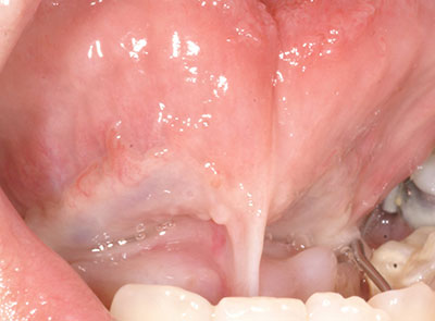 Before picture of Frenectomy treatment