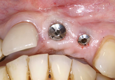 Before picture of Dental Implant Placement and Crown Restoration