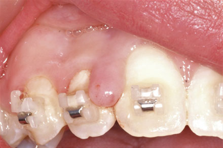 Before picture of Dental Surgery at Encinitas Periodontics & Dental Implants