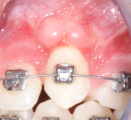 After picture of Dental Surgery at Encinitas Periodontics & Dental Implants