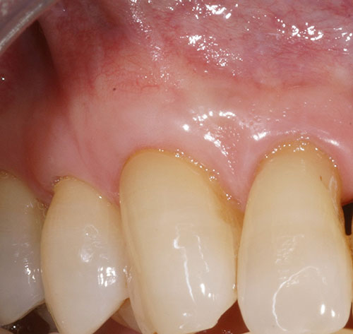 After picture of Grafting treatment