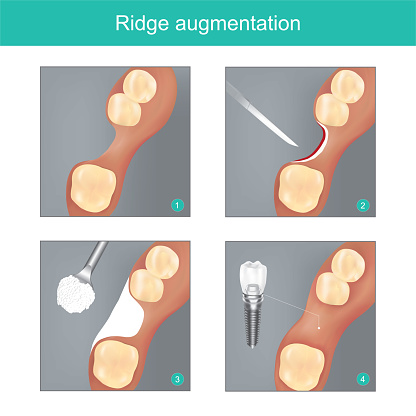 Graphic image of the process of Ridge Augmentation