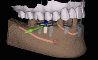 Dynamic 3D Navigation For Dental Implants at Encinitas Periodontics & Dental Implants in Encinitas, CA