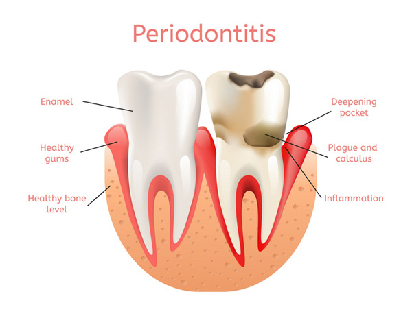 Diagram of a healthy tooth versus a tooth with periodontitis at Encinitas Periodontics & Dental Implants in Encinitas, CA